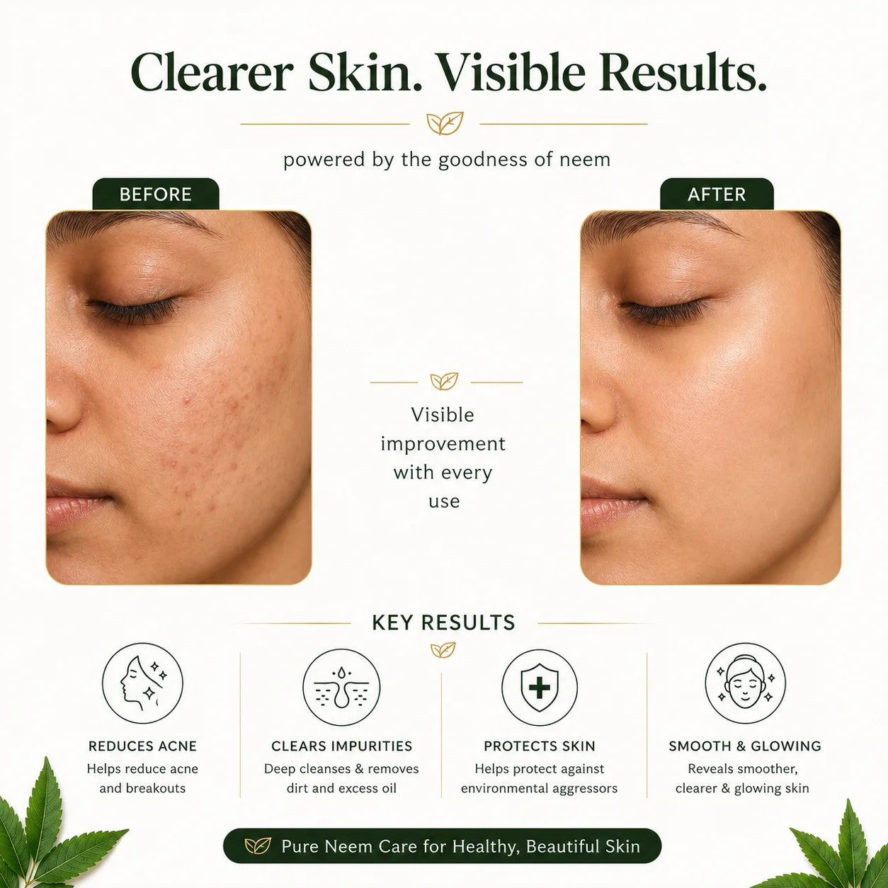 SkinSis Neem Acne Care Soap