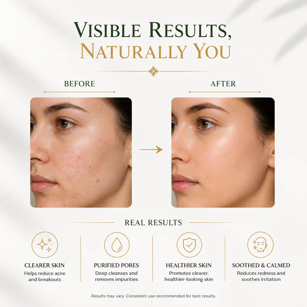 SkinSis Neem & Tulsi Anti-Acne Luxury Soap